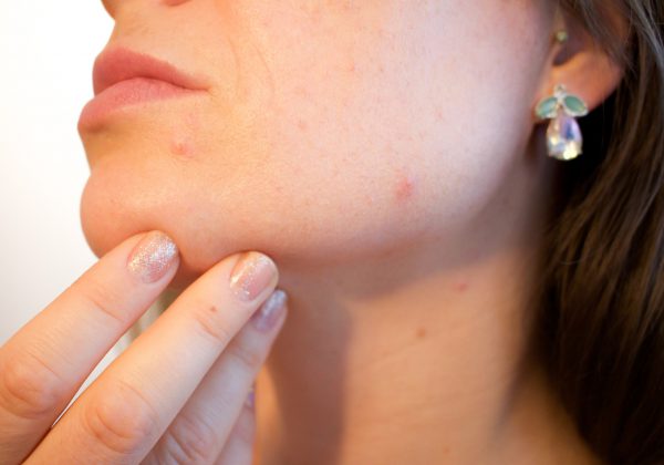 איך לשמור על עור הפנים חלק ונקי מפצעונים?